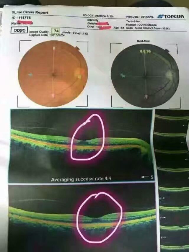 黄金视力眼贴反馈